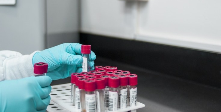 Improved Access to HIV Self-Testing Will Reduce Stigmatization – Prof Ezechi