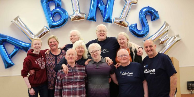 Persons with Albinism Continue to Die of Skin Cancer – Group Laments