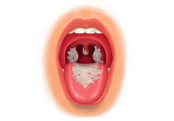 Image of an opened mouth showing the tongue and larynx