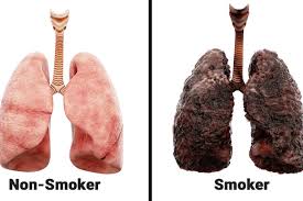 Lungs of a smoker and non-smoker. Source: Paras Hospital