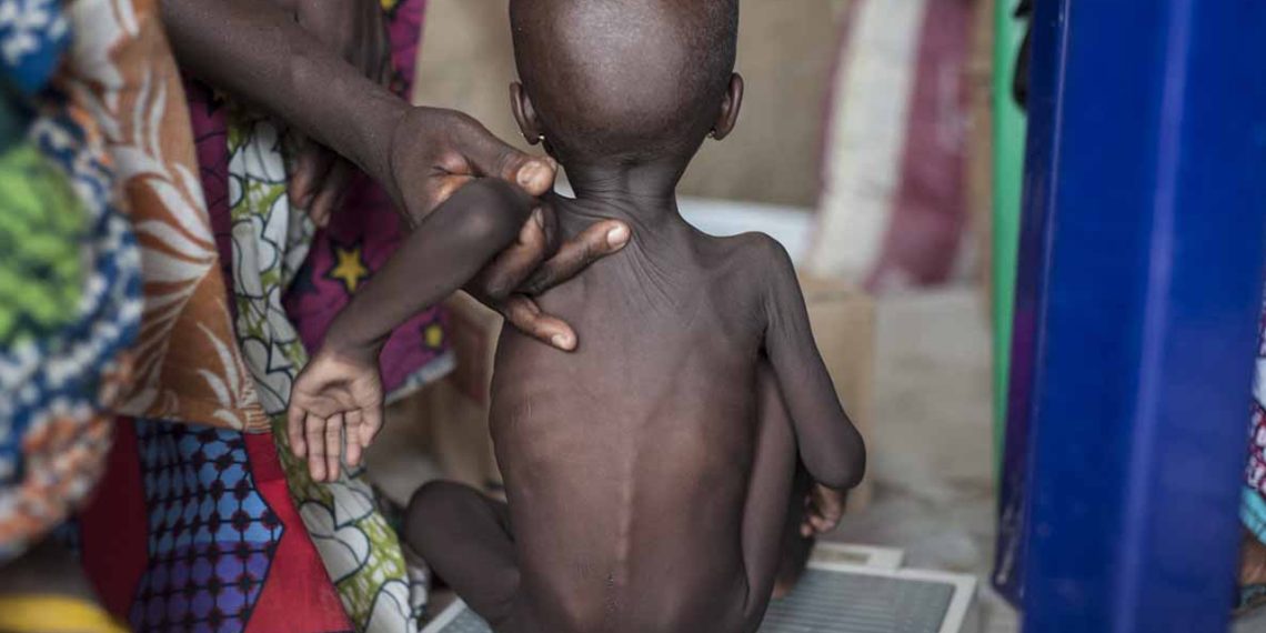Soaring Malnutrition Crisis Hits Northern Nigeria as 652 Children Dead, 10,000 Hospitalised