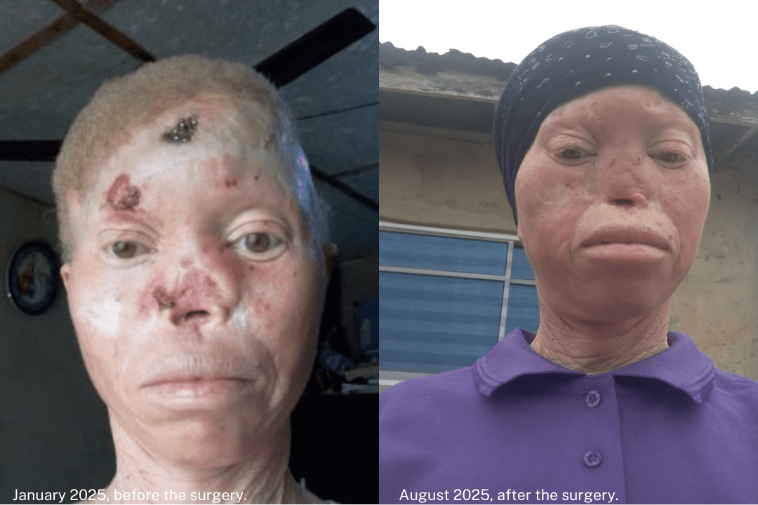 After BONews’ Story, Ibigbami Gets Financial Support for Skin Cancer Surgery