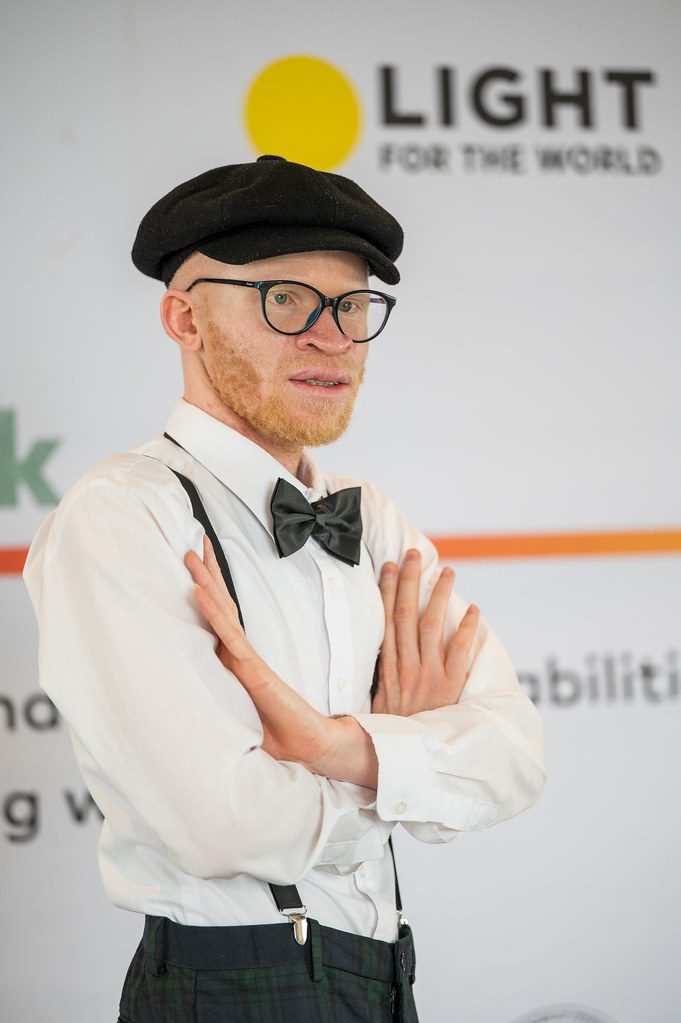 A man with albinism wearing a white shirt with his hands folded around his chest.