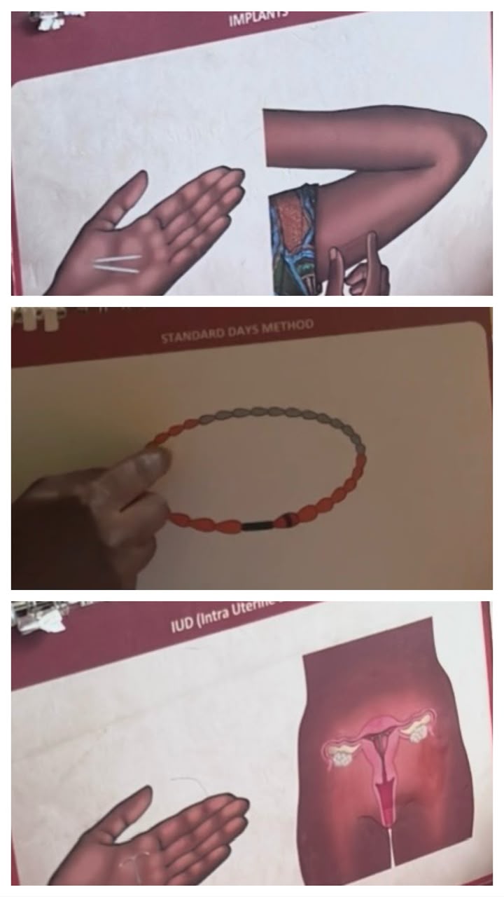 A three-panel educational illustration showing different family planning methods. The top panel shows an arm with a contraceptive implant being inserted under the skin. The middle panel shows a cycle-bead string used for the Standard Days Method. The bottom panel shows an IUD positioned inside the uterus.